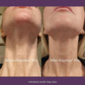 Before-and-after-using-Equinox-Pro-LED-mask:-visibly-reduced-fine-lines