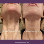 Before-and-after-using-Equinox-Pro-LED-mask:-visibly-reduced-fine-lines