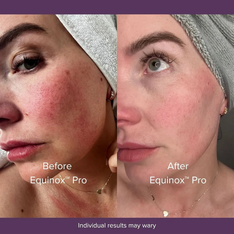 Before and after Equinox Pro LED therapy: clearer skin tone and reduced redness after consistent use