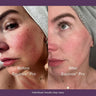 Before-and-after-Equinox-Pro-LED-therapy:-clearer-skin-tone-and-reduced-redness-after-consistent-use