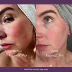 Before-and-after-Equinox-Pro-LED-therapy:-clearer-skin-tone-and-reduced-redness-after-consistent-use