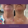 Before-and-after-using-Equinox-Pro-LED-mask:-visibly-firmer-skin-in-the-face-and-neck