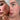 Before and after of a woman's cheek showing reduced redness and rosacea after using the Equinox Pro LED mask